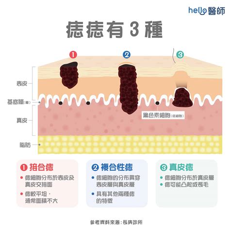 手掌後天長痣|痣形成的原因？痣長毛、痣變多變大是痣病變？5招判別